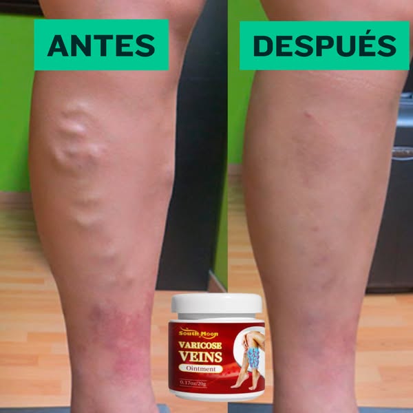 Varicose veins crema para varices