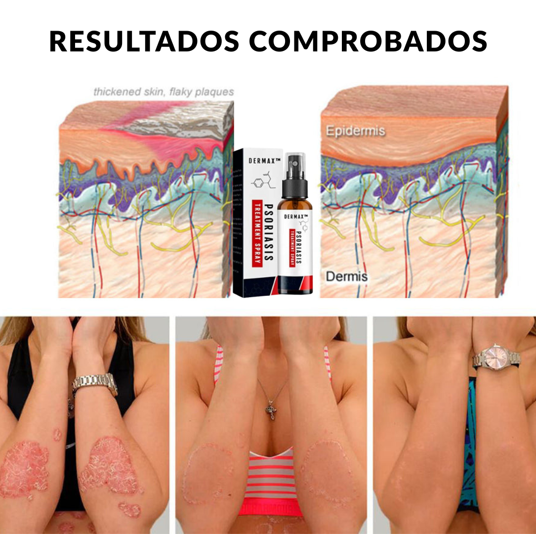 Alivio Rápido en Spray para la Psoriasis