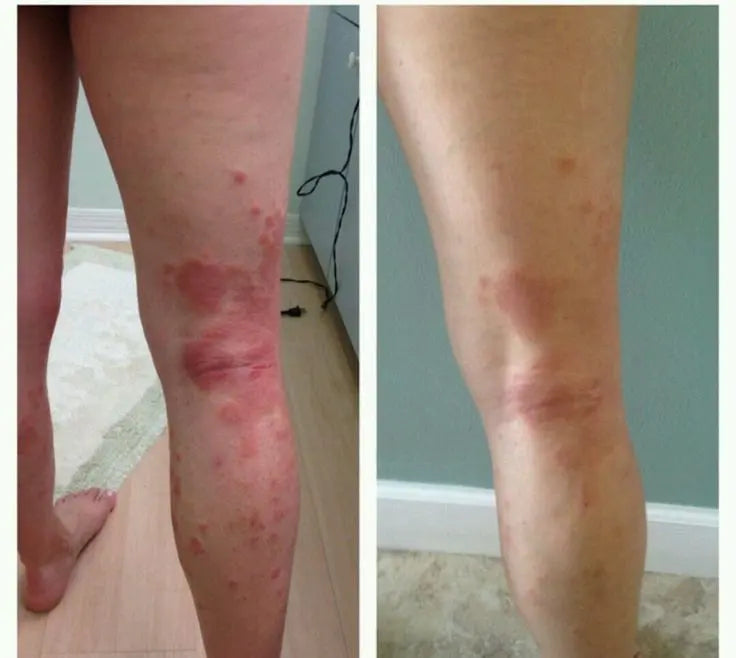 Alivio Rápido en Spray para la Psoriasis