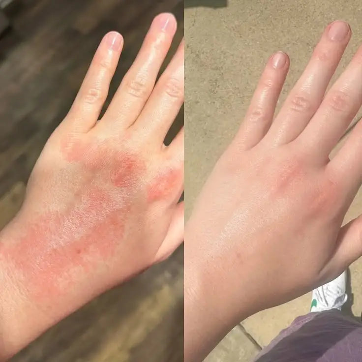 Alivio Rápido en Spray para la Psoriasis